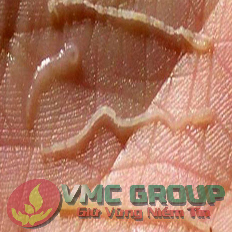 Bệnh phân trắng
